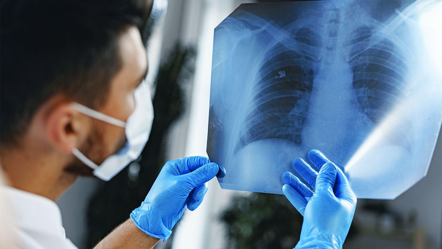 stages of lung cancer 1440x810